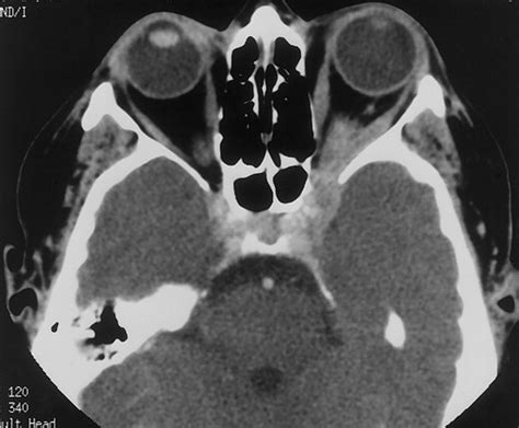 Inflammatory Pseudotumor Radiographics