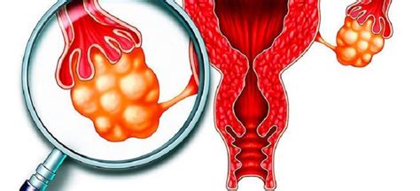 C Mo Prevenir Los Quistes En Los Ovarios Medicina Casera Para El Hogar
