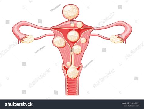 Uterine Fibroids Female Leiomyomas Reproductive System Stock Vector