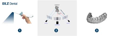 What Is An Intraoral Scanner BLZ Dental Dental Scanner