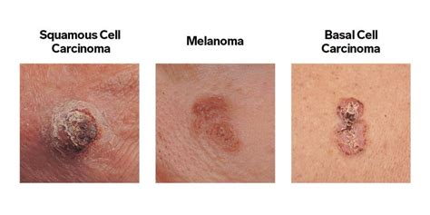 Malignant Skin Lesions