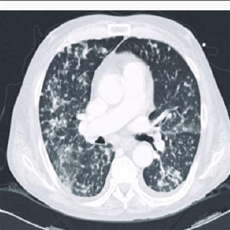 Computed Tomography Of Miliary Tuberculosis Trans Versal Slide Showing Download Scientific