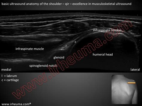 Shoulder Ultrasound Anatomy Qir Basic Msus Anatom Yof Th Flickr