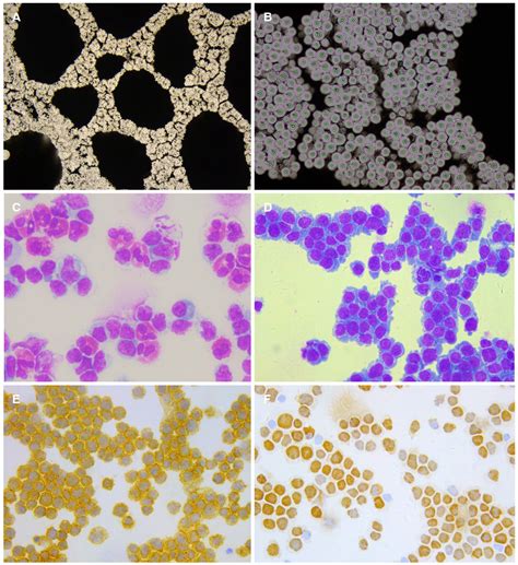 Clinical Application Of Cerebrospinal Fluid Cytology In China