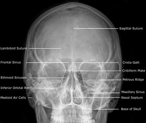 Radiographic Anatomy Of Facial Bones And Mandible With Radiological