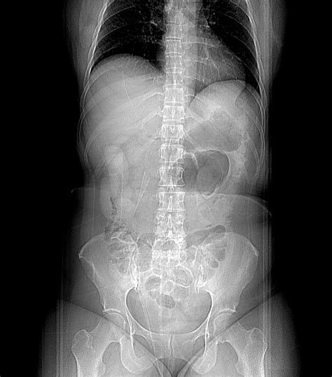 Ulcerative Colitis Image Radiopaedia Org