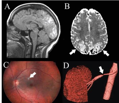 A B Brain Mri Showing Subcortical And Cortical Hyperintense Signal