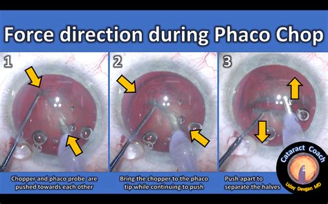 Understanding Force Directions In Phaco Chop Cataract Coach