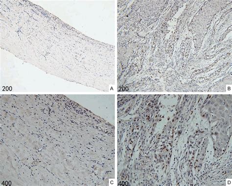 Stat Is A Key Pathway In Primary Intraosseous Squamous Cell Carcinoma