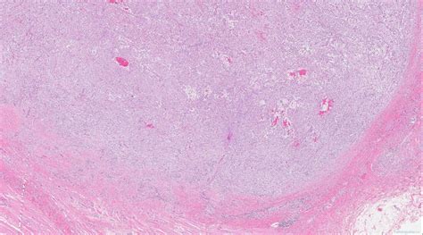 Nodular Fasciitis Atlas Of Pathology