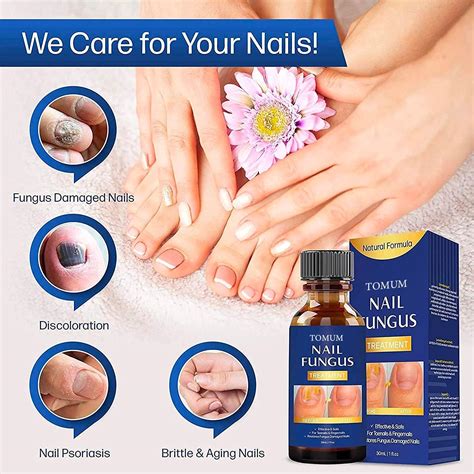 Toenail fungus treatment Nail Fungus Treatment for Toenail Toe Nail ...