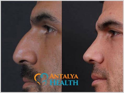 Rhinoplasty Nose Job Turkey Dental Clinic Turkey