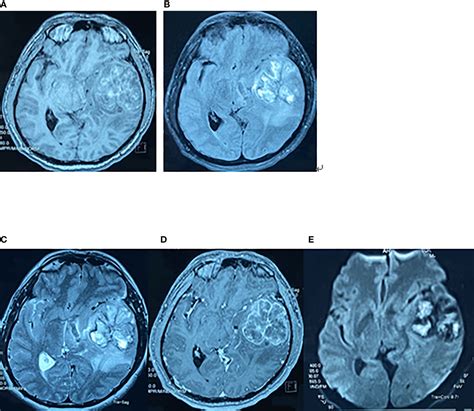 Frontiers Bone Metastases Of Glioblastoma A Case Report And Review