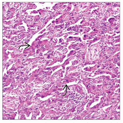 Epithelioid Hemangioendothelioma | Basicmedical Key