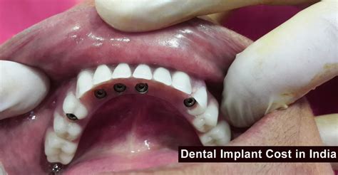 Dental Implant Cost In India Updated