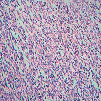 A Tumour Composed Of Spindle Cells Arranged Into Fascicles Case 2