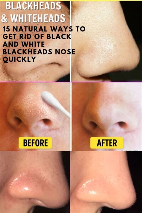 How To Remove Blackheads On Nose Quickly Howtoremvo