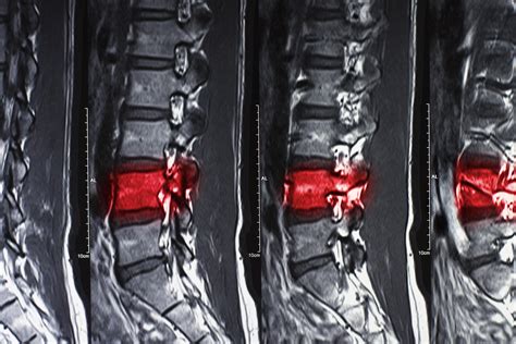 Compression Fracture Of The Spine Plainsboro Township Nj Freehold