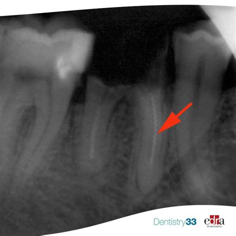 Vertical Fracture Of The Root Dentistry33