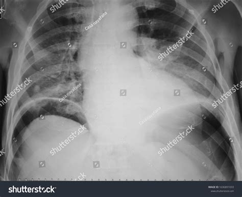 45 Air under diaphragm Images, Stock Photos & Vectors | Shutterstock