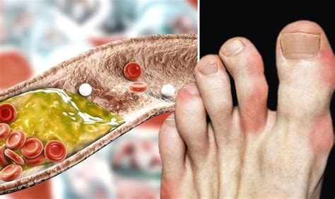 High cholesterol symptoms: Bumps that are different shapes on feet are a sign | Express.co.uk