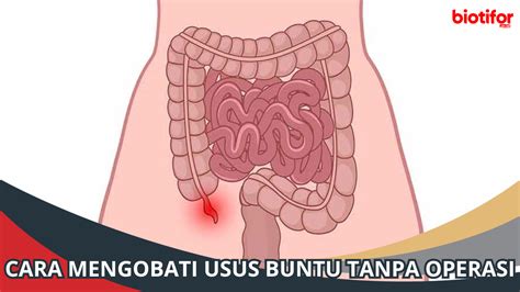 Cara Mengobati Usus Buntu Tanpa Operasi Biotifor