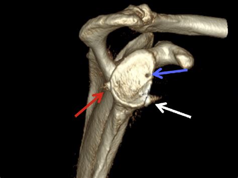 En Face View Of The Glenoid In The Right Shoulder On Computed Download Scientific Diagram