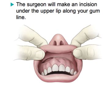 Pituitary Tumor Surgery - Blue Wave Dental Implants and Oral Surgery