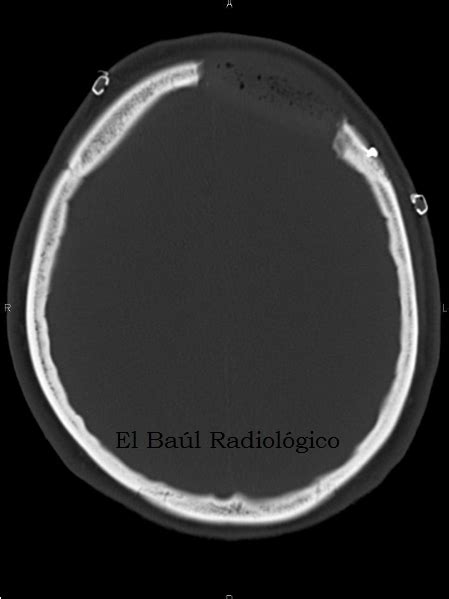 El Baúl Radiológico Quiste Óseo AneurismÁtico Craneal Cranial