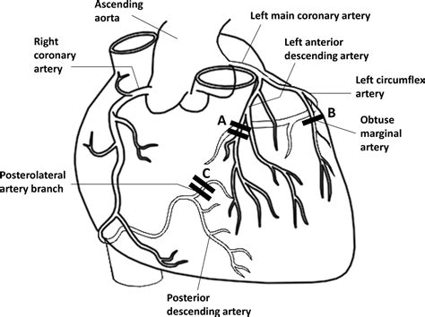 Heart Coronary Anatomy Tetralogy Fallot Arterial Figure Correlations