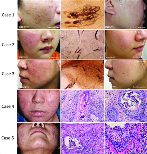 Clinical Features Demodex Overgrowth And Histopathology Of Five Cases