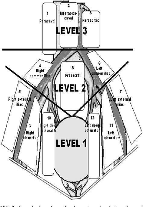 Figure 1 From Extended Pelvic Lymph Node Dissection Before Or After