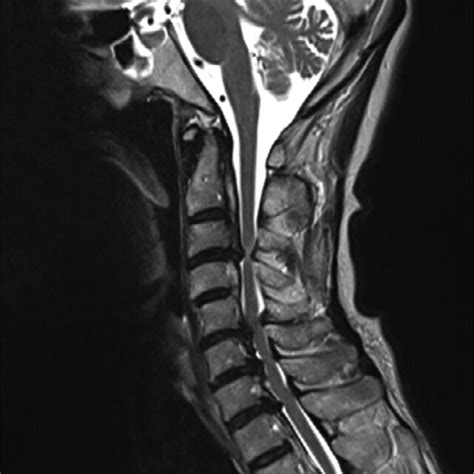 Sagittal T2‐weighted Magnetic Resonance Image Mri Of The Cervical