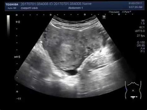 Ultrasound Video Showing Fibroid In Uterus With Hemorrhagic Ovarian