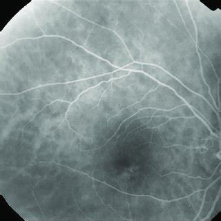 Fluorescein Angiography Image Of The Right Eye Showing Neovascular