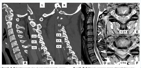 Figure From Intraoperative Anterior Migration Of The Prestige Lp