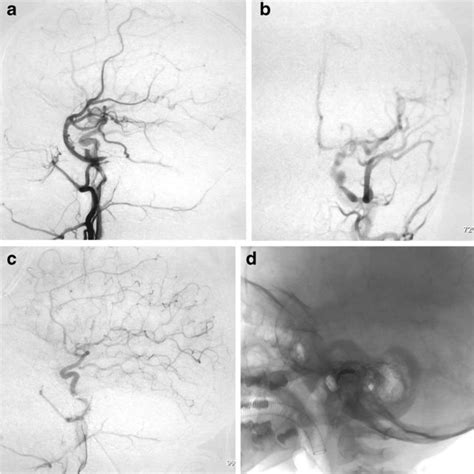 A Left Carotid Artery Angiogram Lateral View B Left Carotid Artery