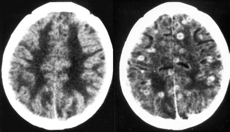 Cysticercosis Epidemiology In Spain What S New Epilepsyu