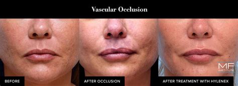 Corrective Injections Dissolving Facial Fillers With Hylenex Hyaluronidase In San Francisco