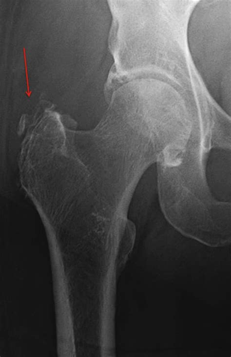 Radiographic Risk Factors And Signs Of Abductor Tears In The Hip