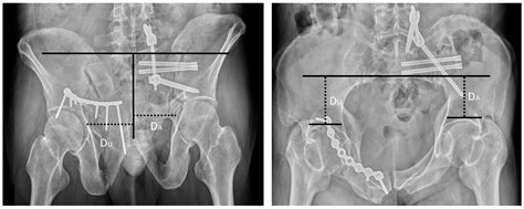 Pelvic Inlet And Outlet Views