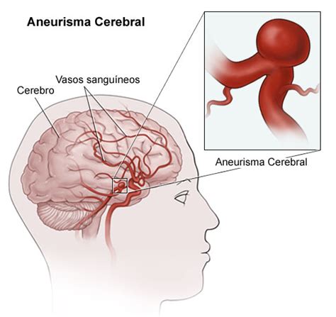 Resonancia Magnética De Aneurisma Cerebral