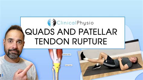 Quadriceps And Patella Tendon Rupture Expert Physio Review YouTube