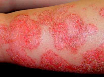 Numular O Eczema Numular Tratamiento Y Causas Eccema Numular