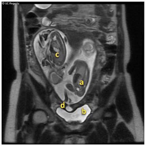 Ultrasound Images A Dichorionic Diamniotic Twin Pregnancy With