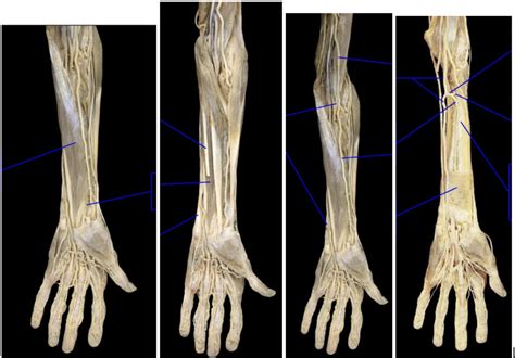 Anterior Antebrachium Diagram Muscles Arteries Fascia Diagram Quizlet