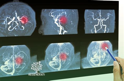 Avc O Que E Como Prevenir Cl Nica Regenerati Neurologia