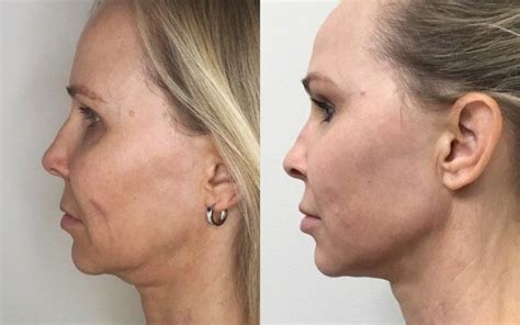 Agnes Precision Rf Microneedling Prescription Aesthetic And Wellness