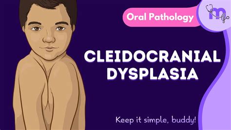 Cleidocranial Dysplasia Features Oral Manifestation Treatment