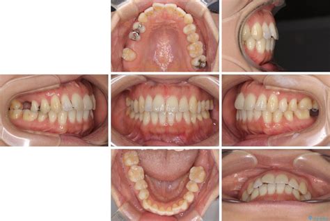 後戻りの再矯正治療と欠損部の補綴治療 東京駅前しらゆり歯科東京駅八重洲口・日本橋駅